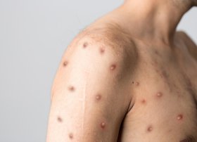Bu dövlətdədə meymunçiçəyi (mpox) virusu aşkarlandı