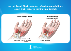 Karpal Tunel Sindromunun müayinə və müalicəsi icbari tibbi sığorta təminatına daxildir