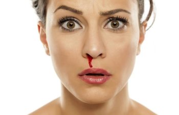 Burun qanaması nədən xəbər verir? - Səbəbləri və müalicəsi