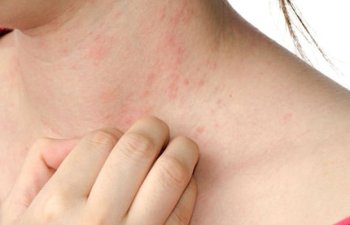 Dermatoloqlar koronavirusun daha bir simptomunu aşkar ediblər