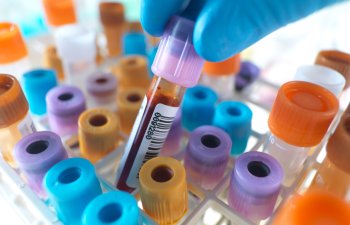 Azərbaycanda indiyədək aparılan koronavirus testlərinin SAYI AÇIQLANDI