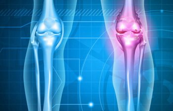 Osteoartrozun kliniki mənzərəsi