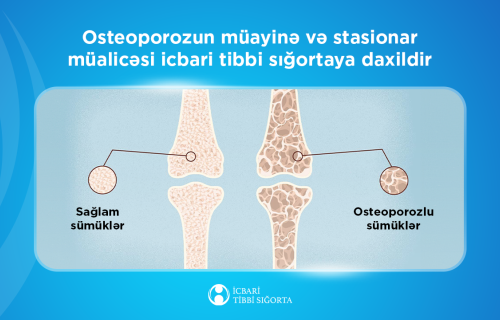Osteoporozun müayinə və stasionar müalicəsi icbari tibbi sığortaya daxildir