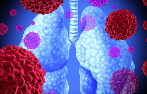 Kiçik hüceyrəli olmayan ağciyər xərçəngi: səhər saatlarında immunoterapiya daha effektivdir