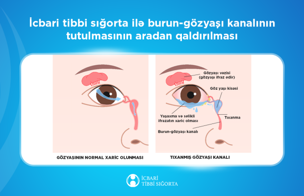 Gözyaşı axarının bərpası əməliyyatı icbari tibbi sığortaya daxildir