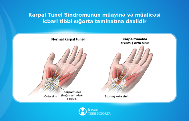 Karpal Tunel Sindromunun müayinə və müalicəsi icbari tibbi sığorta təminatına daxildir
